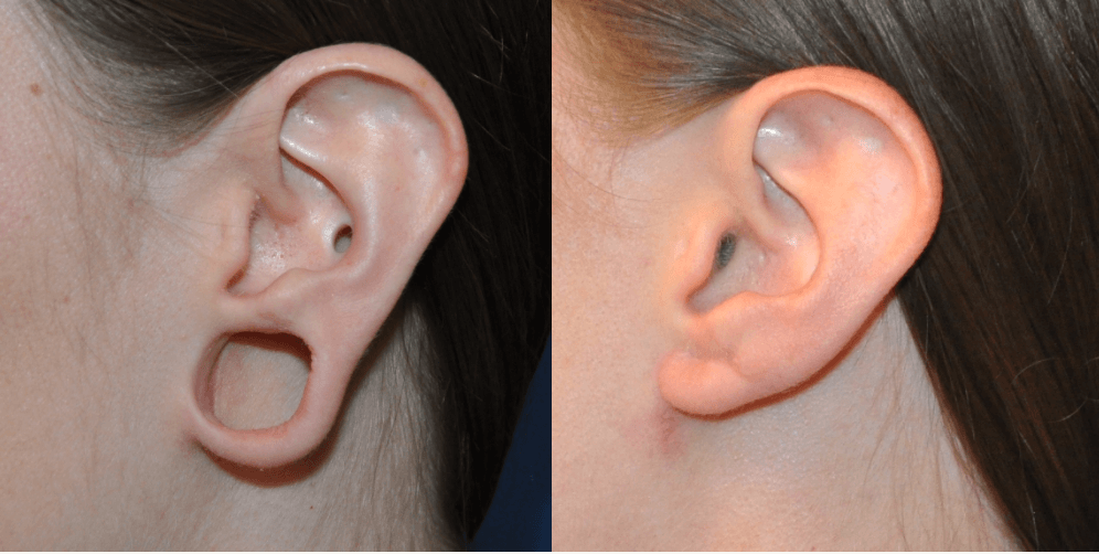 Ear Lobe Repair Nivi Skin Clinic